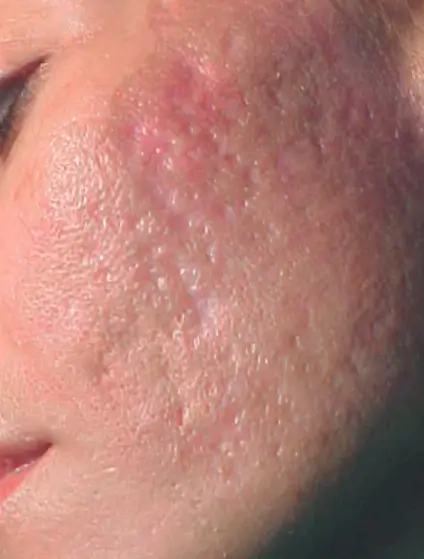 Close-up of pitted acne scarring on cheek skin.