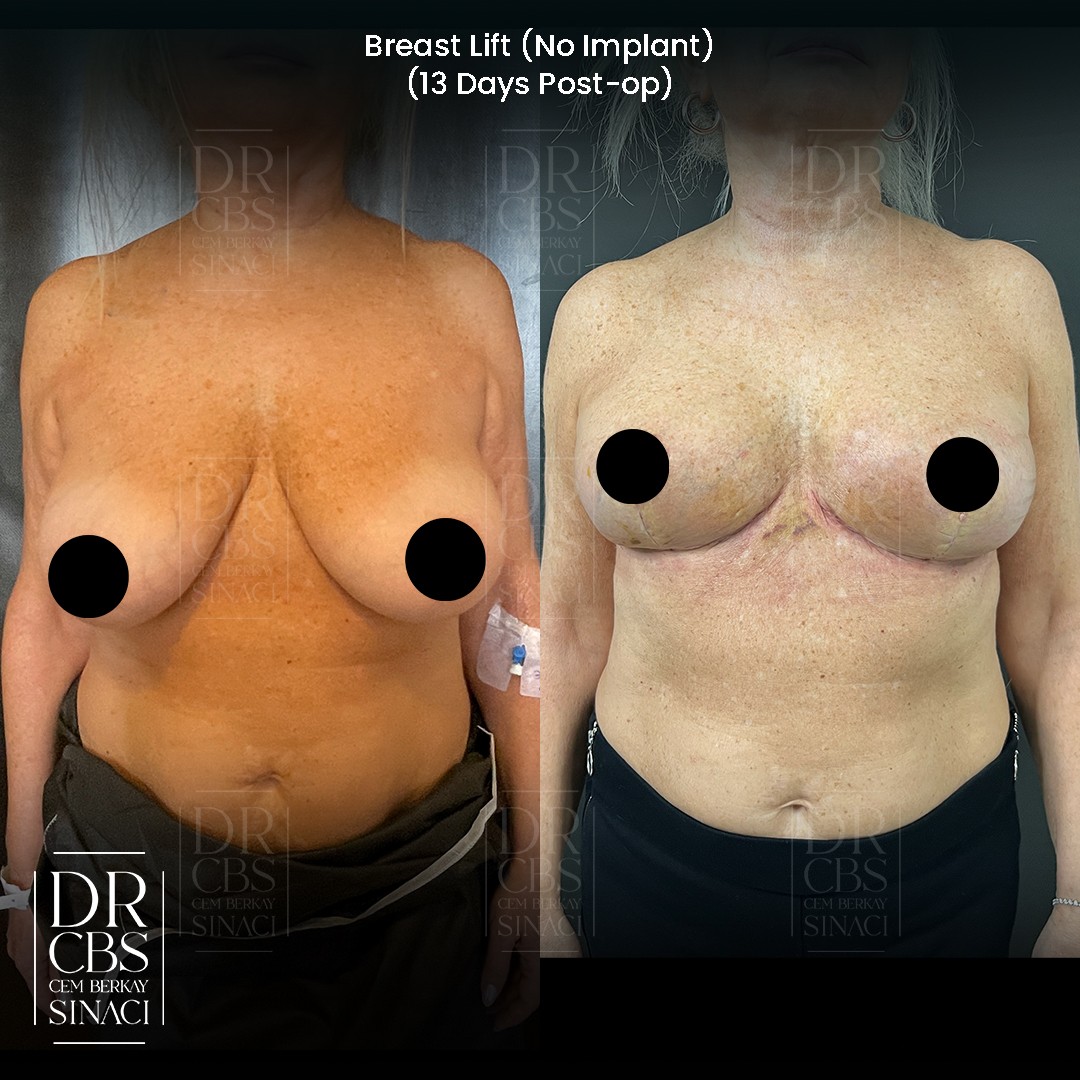 breast lift before after 13 days post-op no implant only auto augmentation front view