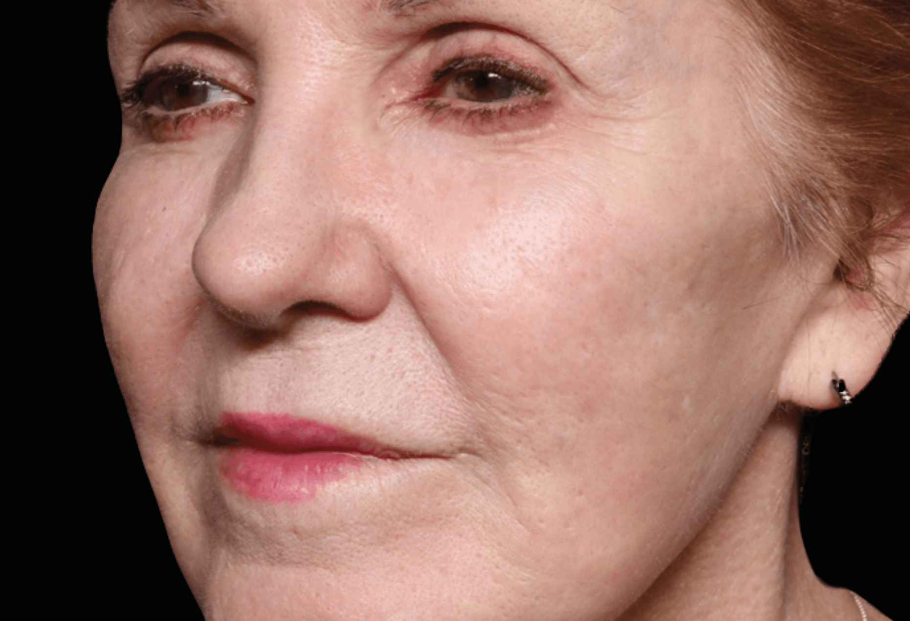 Exion RF Microneedling After