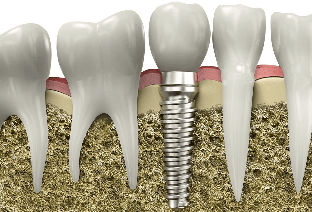Single dental implant