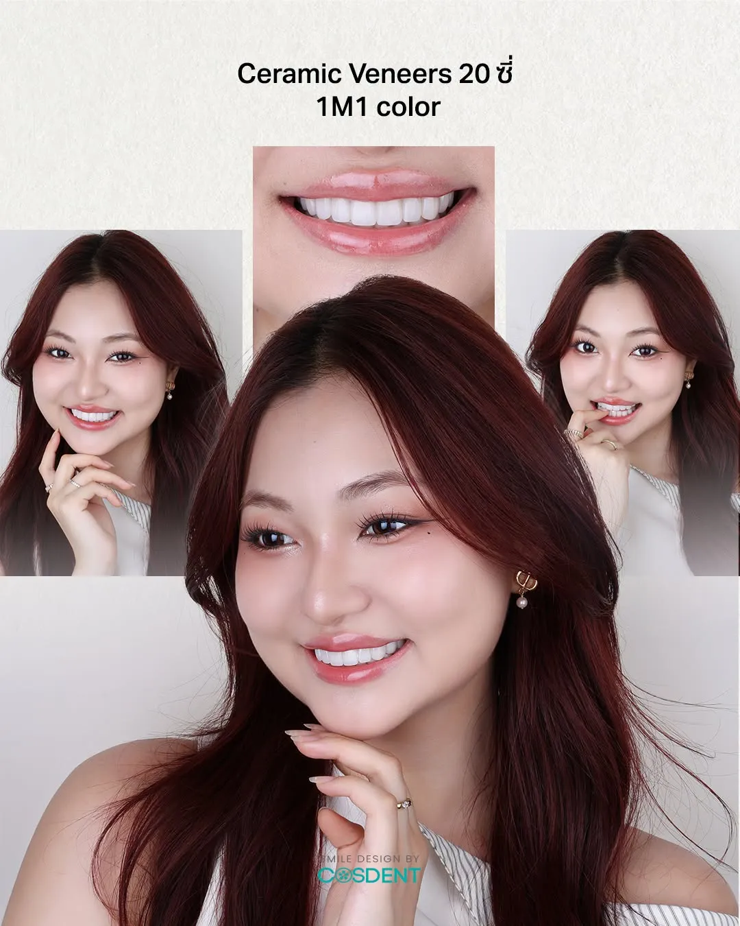 Ceramic veneers on 20 teeth in shade 1M1, warm tone — smile design case at COSDENT Bangkok