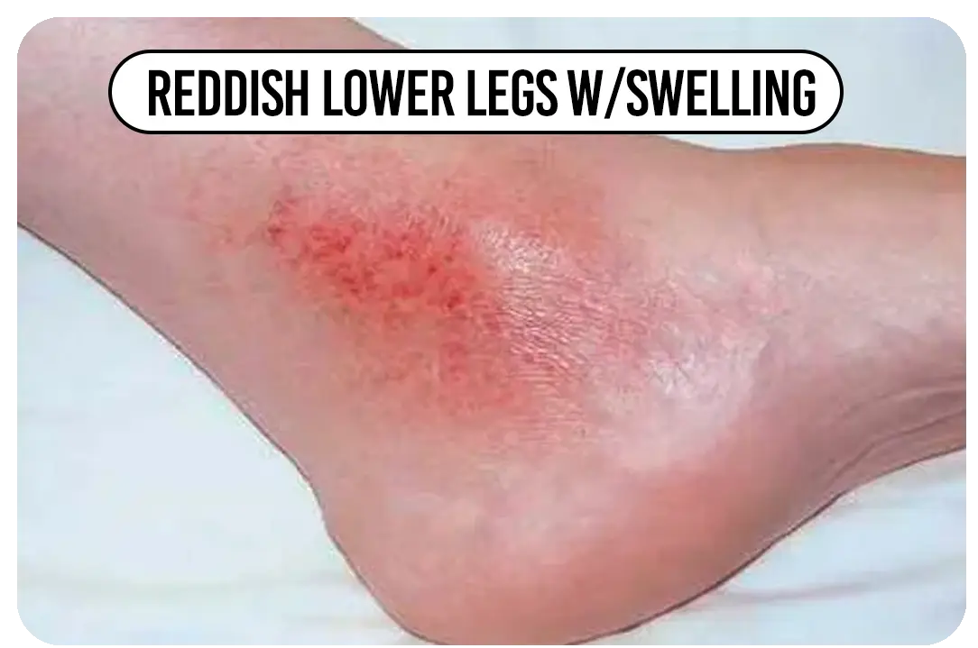 Reddish lower legs w/ swelling