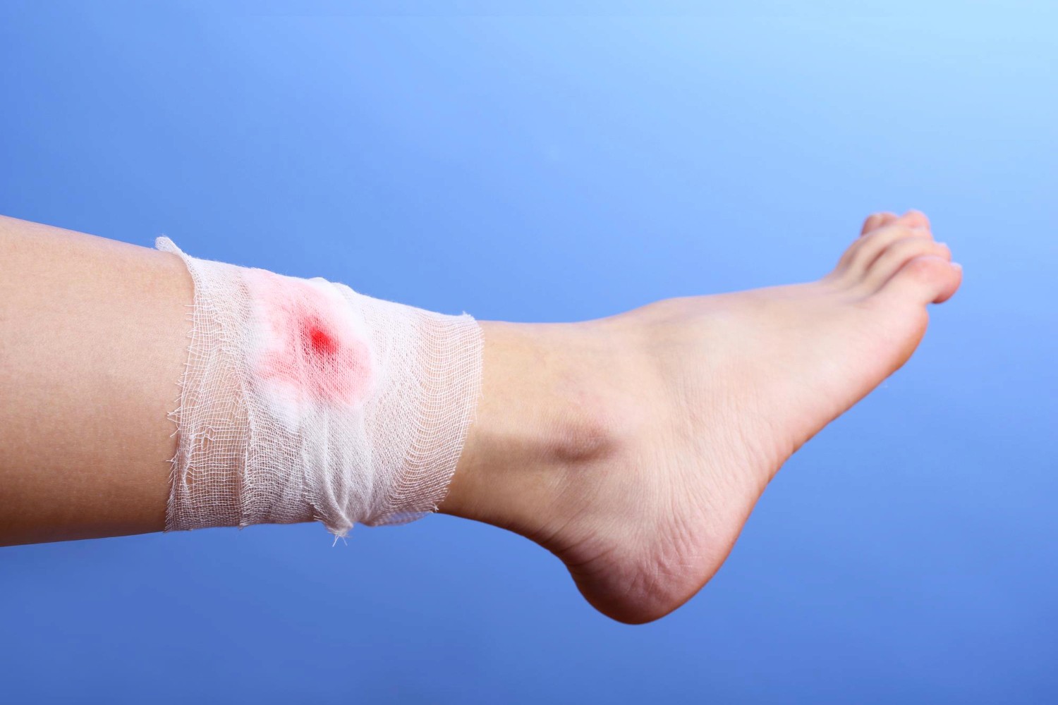 diabetic wound