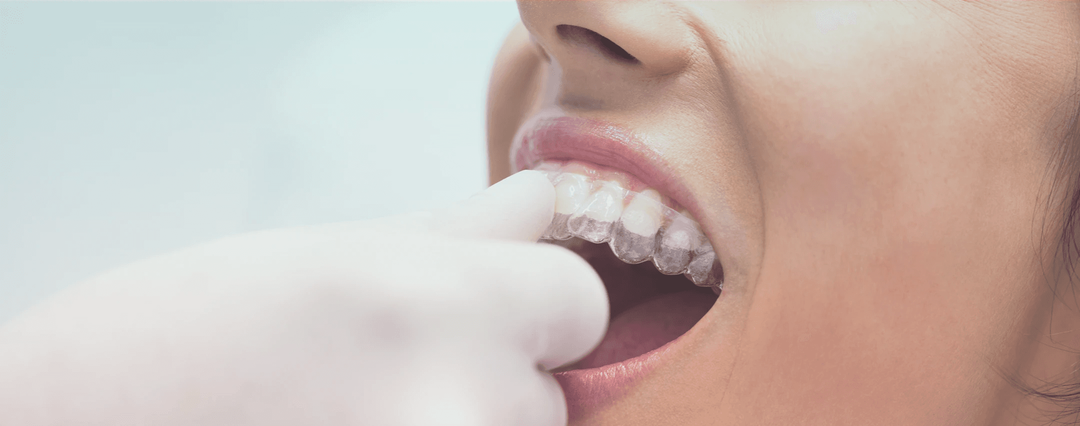 INVISALIGN CLEAR ALIGNERS
