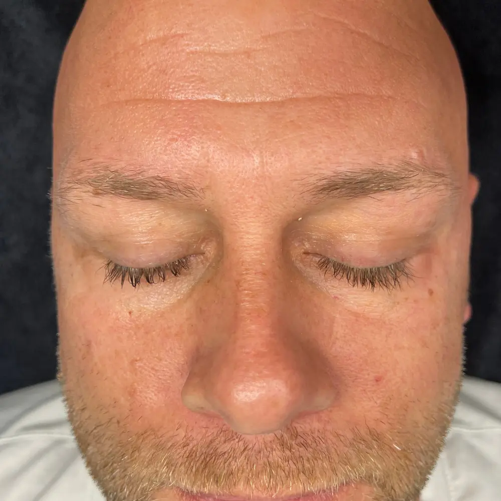 After men's facial at The Vancouver Aesthetician — under eye wrinkles and dark circles visibly reduced and skin looking refreshed, rested and youthful