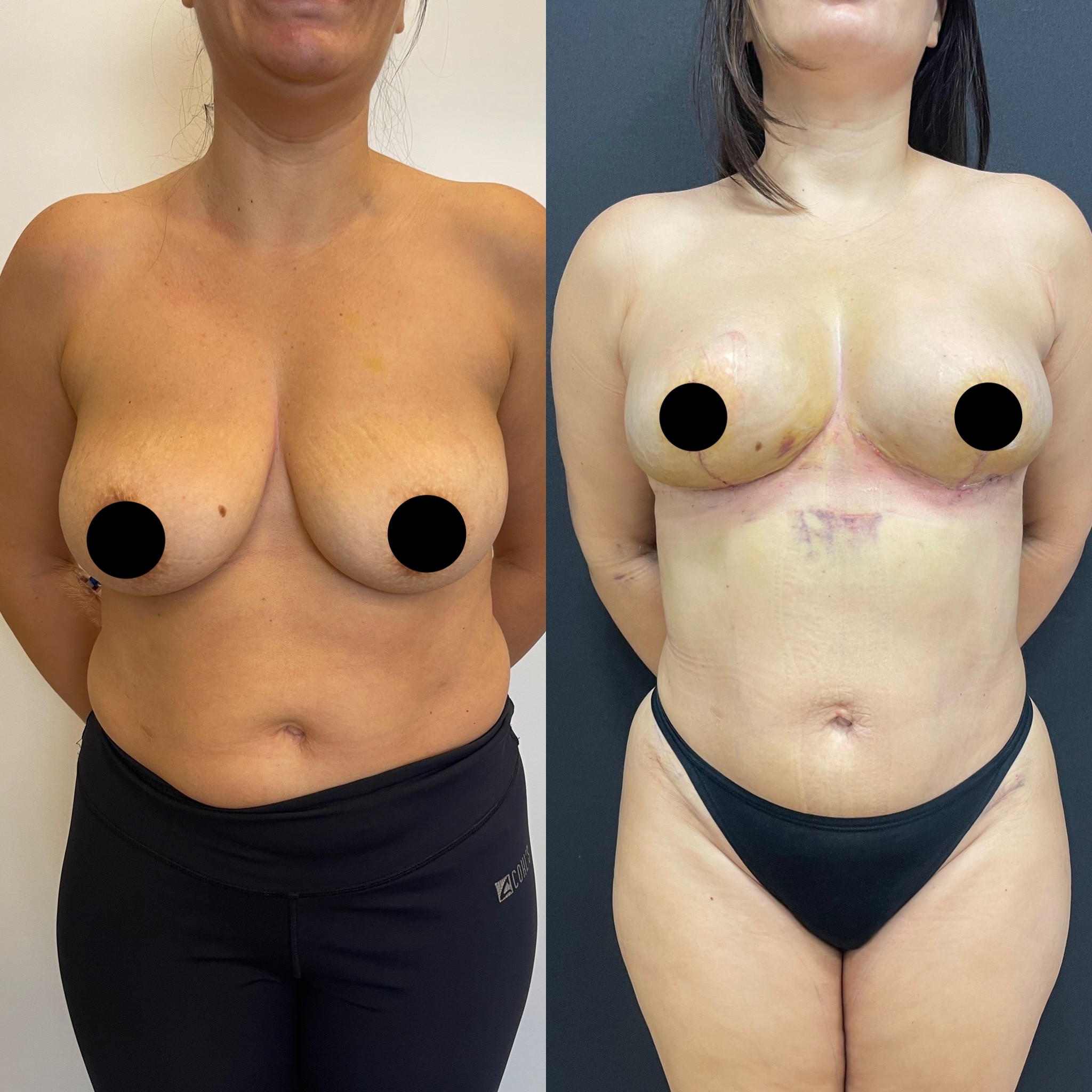 breast lift internal bra technique before after front view