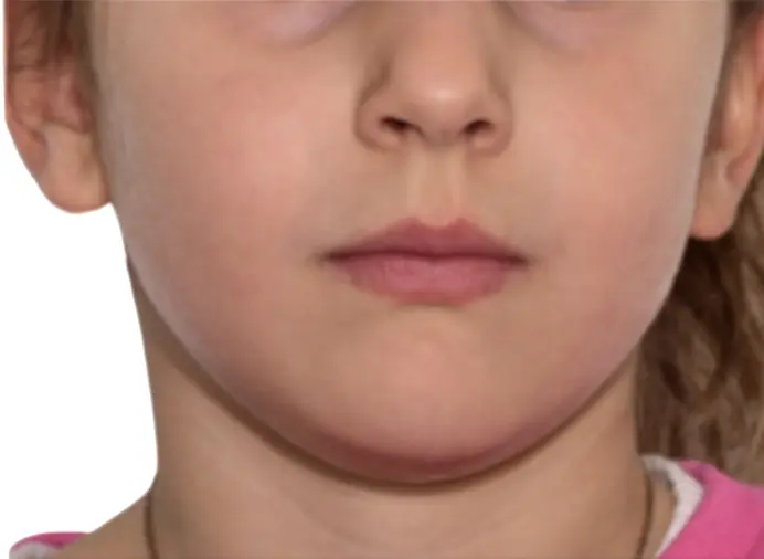 Before and after comparison: more relaxed smile, less muscle tension after “unblocking” the deep bite and “releasing” the lower jaw forward. Profile changes, better lip competence.