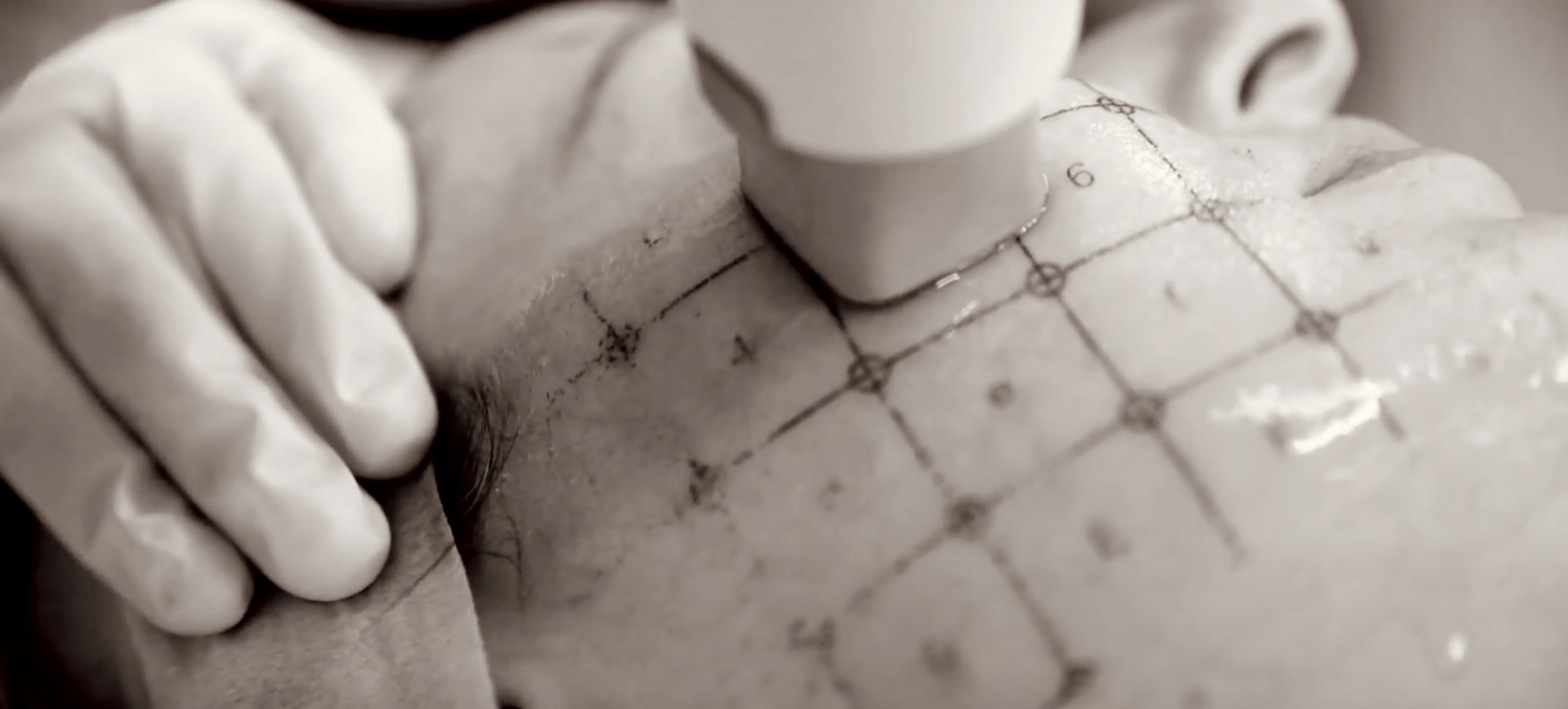 Hautstraffung, Lifteffekt, Halsstraffung und Kollagenboost Gesicht mit Thermage FLX Bad Wörishofen Allgäu