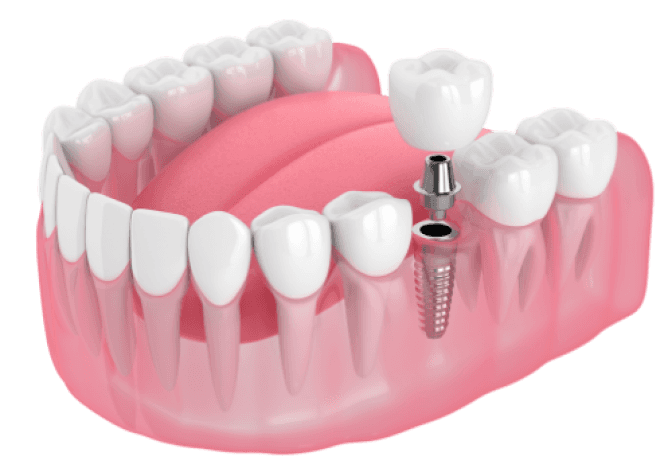 3d model of dental implants