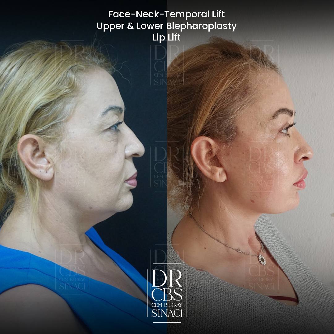 deep plane facelift and upper blepharoplasty 7 months post-op before after right side view