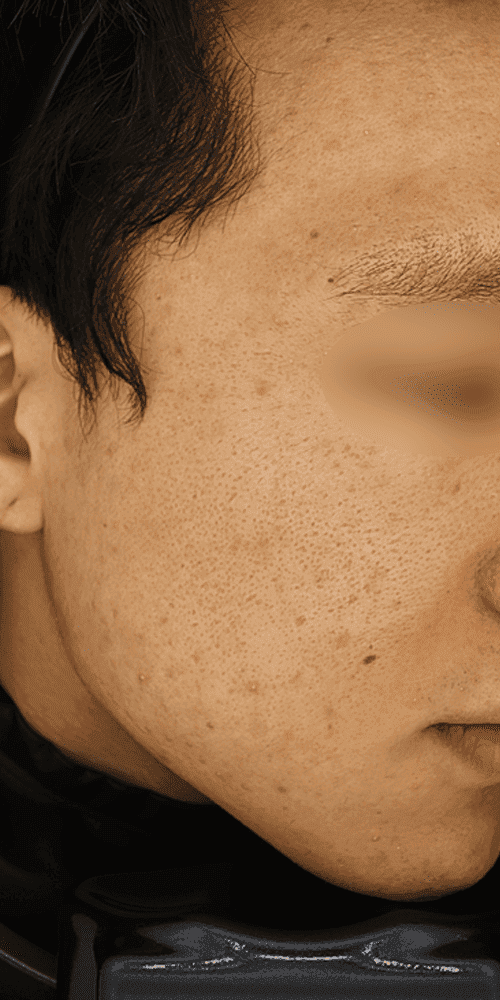 Acne - After