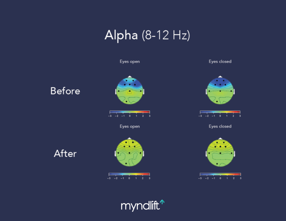 This image displays the alpha high frontal regions both before and after Myndlift neurofeedback training.