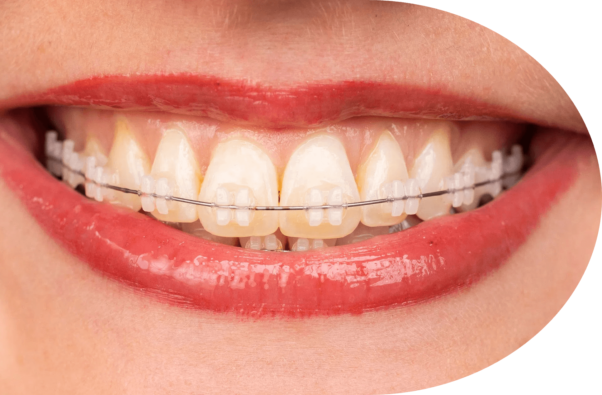 正畸协会认证牙医，AiCare Orthodontics，位于加州橙县，芳泉谷，尔湾，为全年龄段提供正畸服务