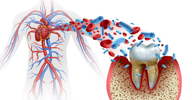 Oral health and CVD connection 