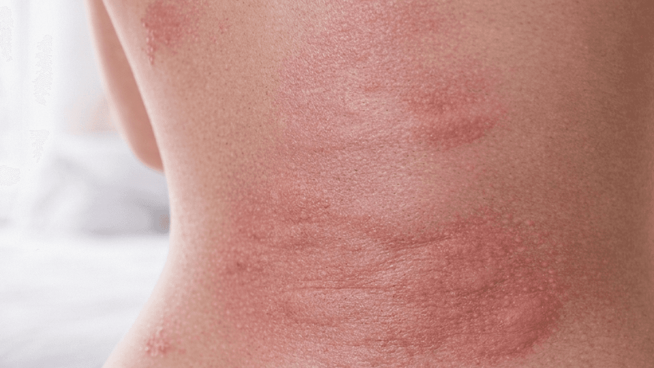 Réaction allergique sévère aux piqûres de punaises de lit sur le flanc et le dos
