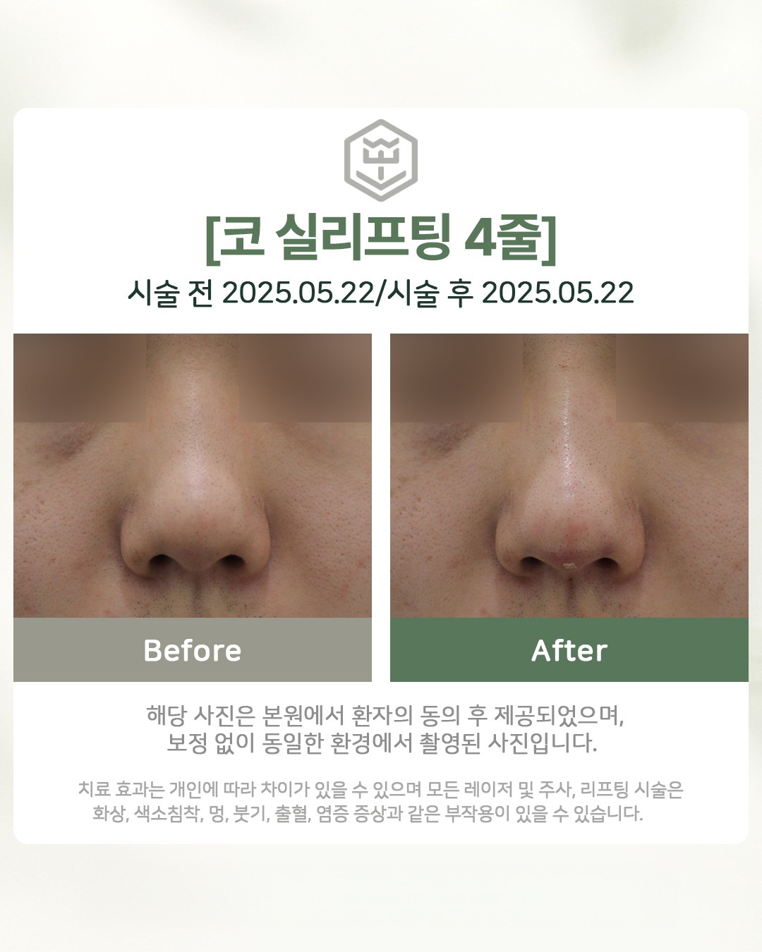 코실리프팅 4줄