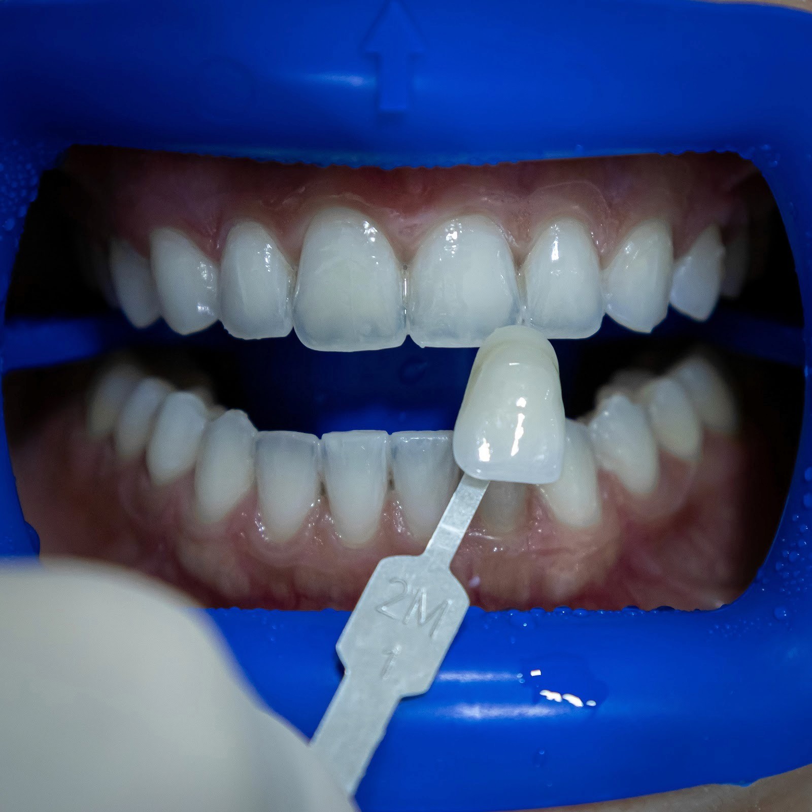 Cosmetic dentist at Bella Medical carefully placing a veneer on a patient's tooth during a Hollywood Smile procedure.