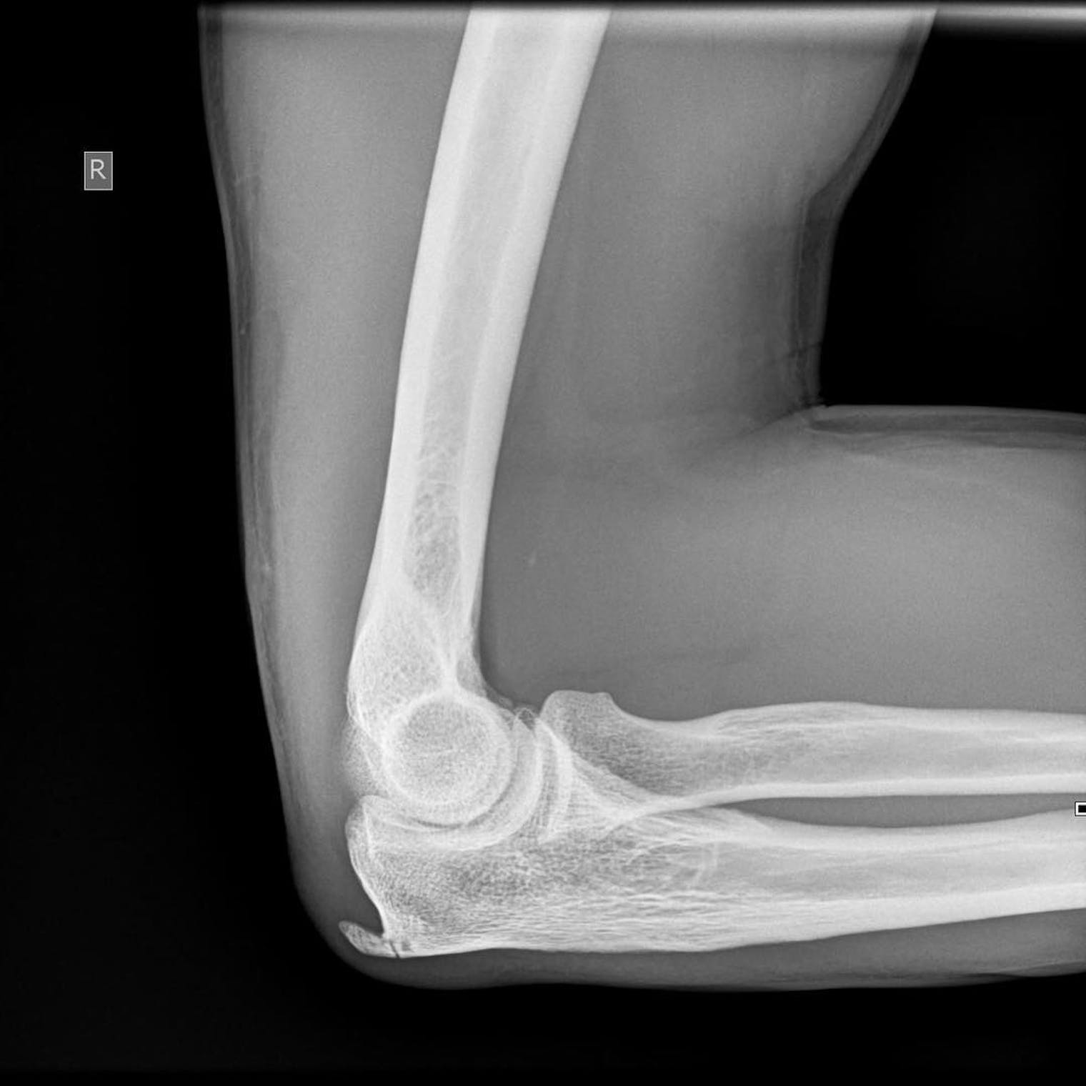 Fractured Elbow