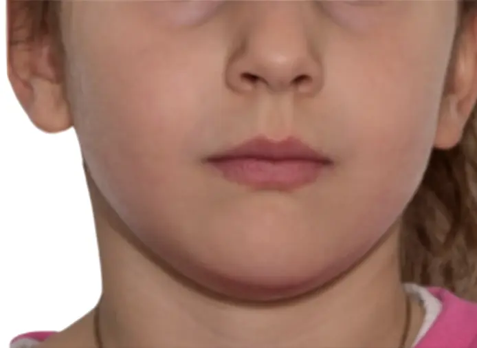 Right after the overlays cementation