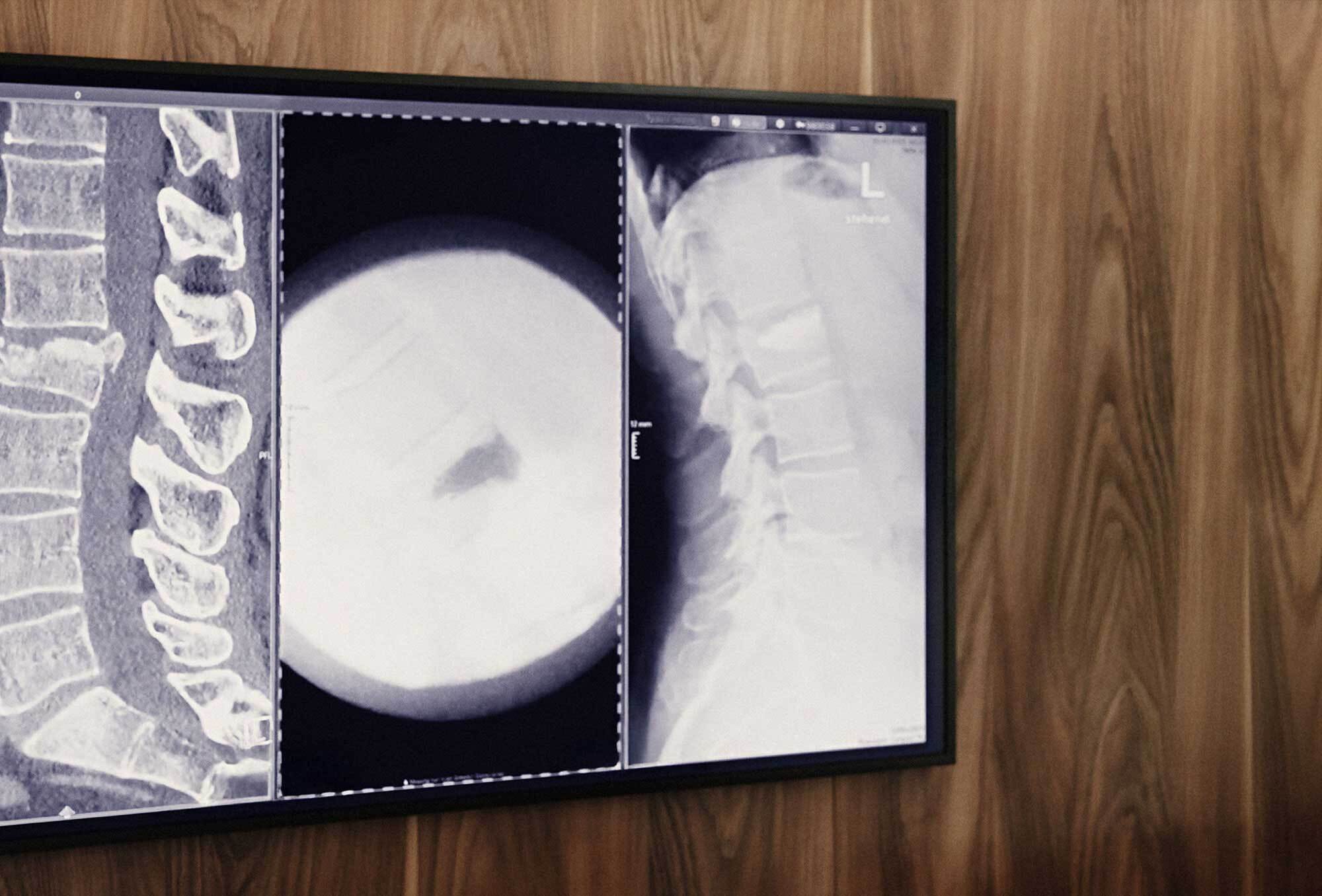 Vertebroplastie / Kyphoplastie