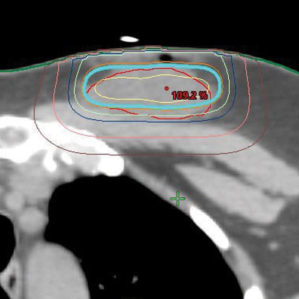 RT-SPOT above skin line, digital image