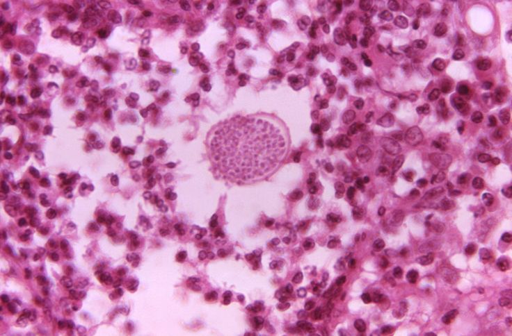 Classic Fabry Disease versus Late-Onset Fabry: What Is the Difference?