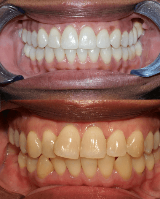 Crowns at ScarboroSmiles Before and After at ScarboroSmiles Dental Clinic in Scarborough, ON | Best dentist in Scarborough, ON.