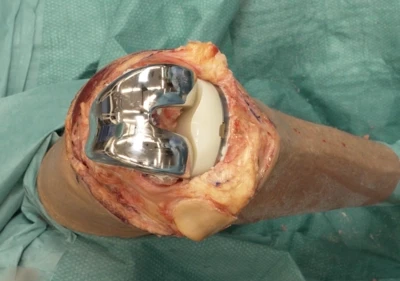 Total knee arthroplasty (mechanical alignment)