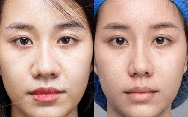 Thu nhỏ đầu mũi là kỹ thuật thẩm mỹ giúp cải thiện dáng mũi to, thô