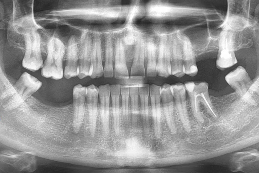 Fogászati Implantátum Tájékoztató