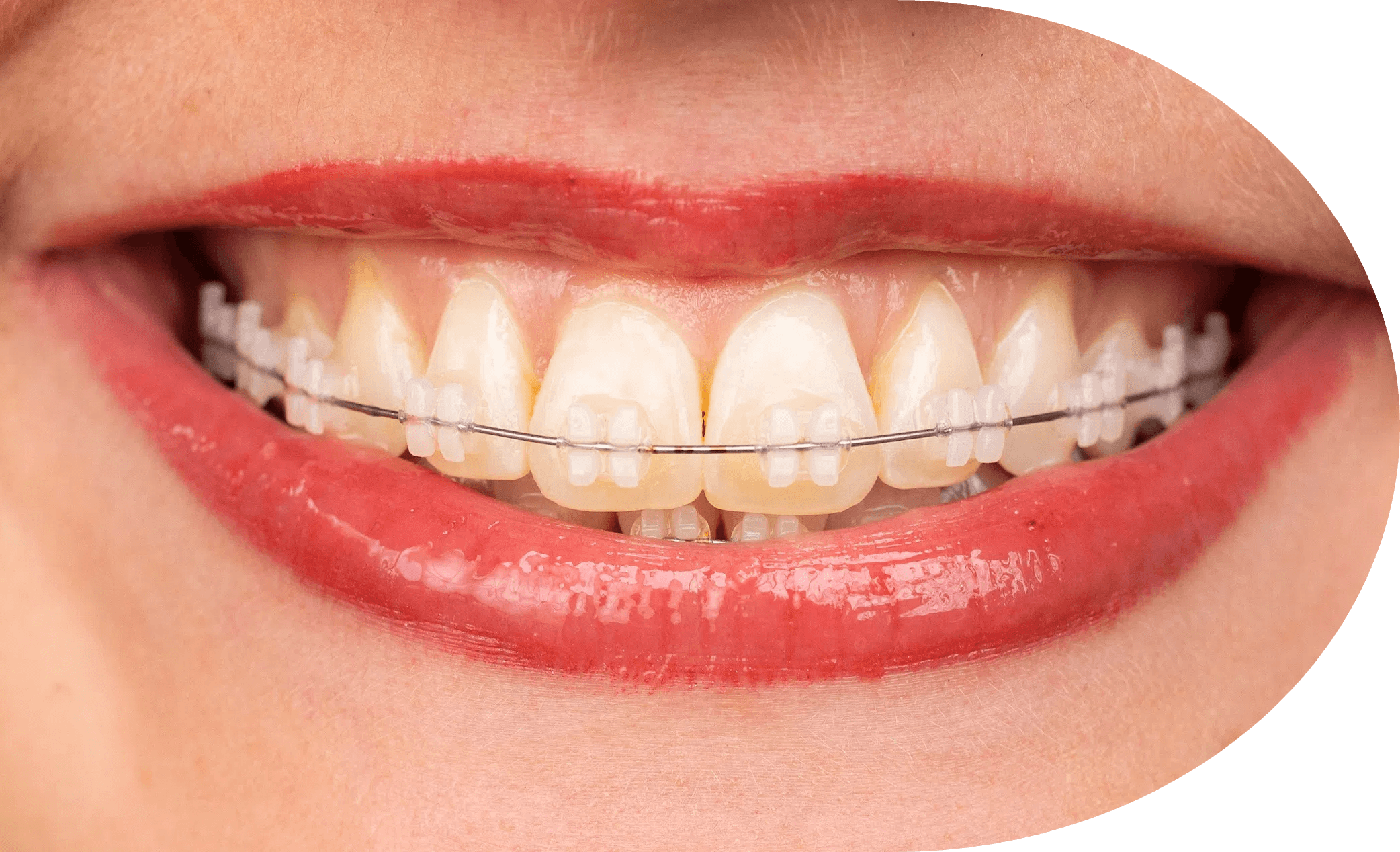 正畸协会认证牙医，AiCare Orthodontics，位于加州橙县，芳泉谷，尔湾，为全年龄段提供正畸服务
