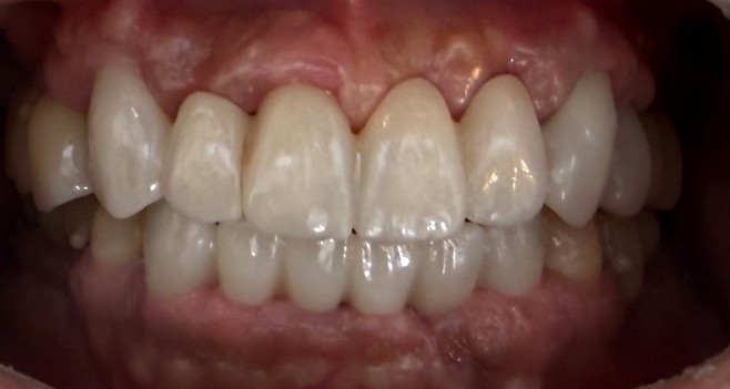 풀 셋팅한 상태