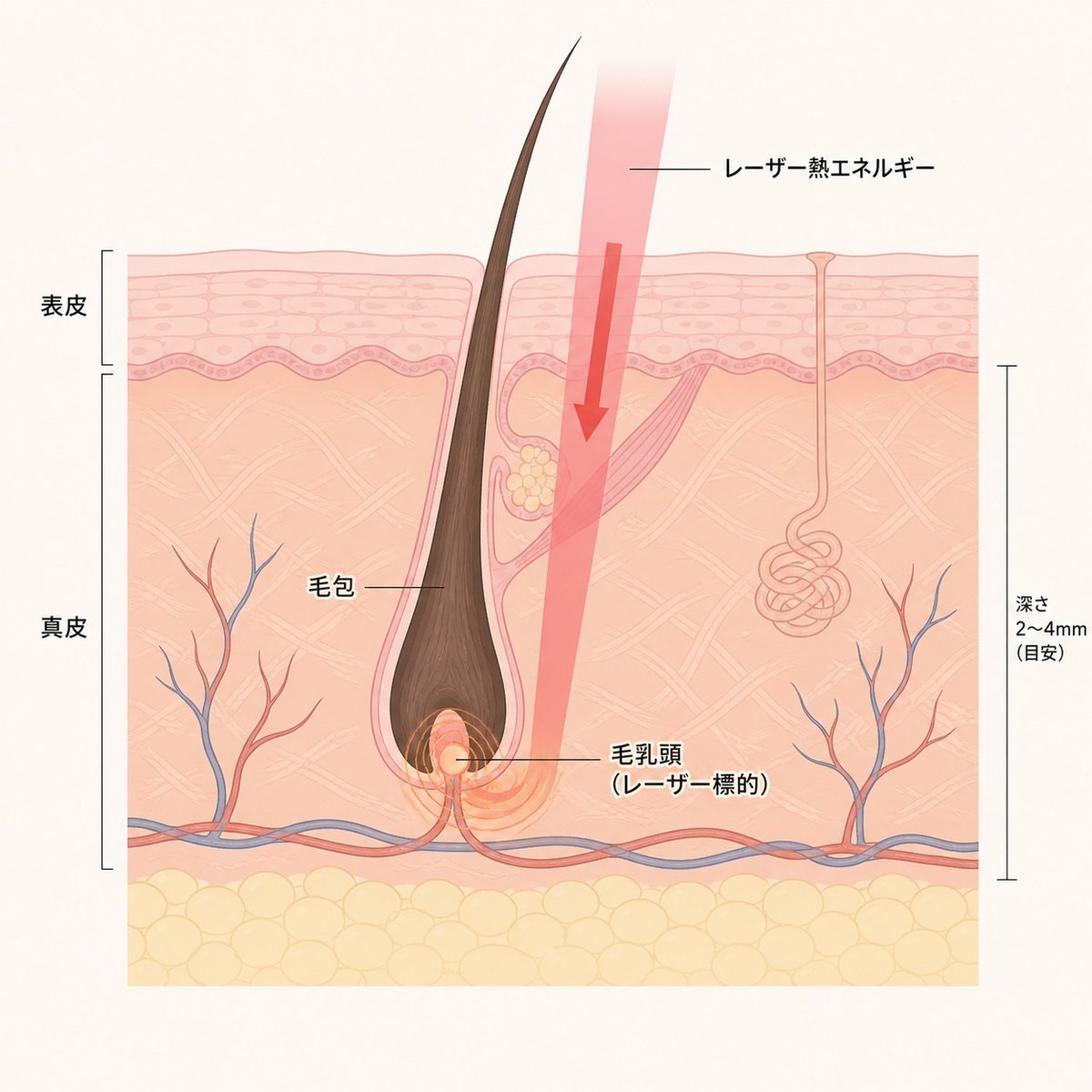 皮膚断面図：医療レーザーが毛乳頭を標的として毛包を処理するしくみ
