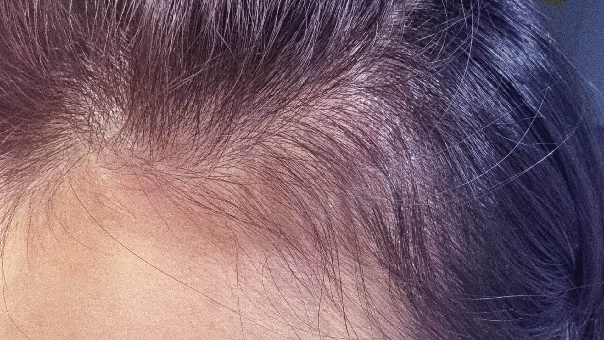 Cận cảnh đường chân tóc thưa và da đầu lộ rõ do rụng tóc sớm