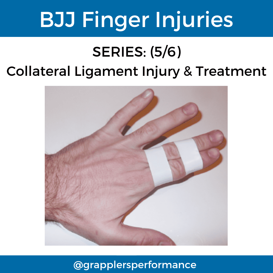 Illustration of collateral ligament injury showing partial or complete tear on the side of the PIP joint. The finger is swollen and deviated sideways under stress.