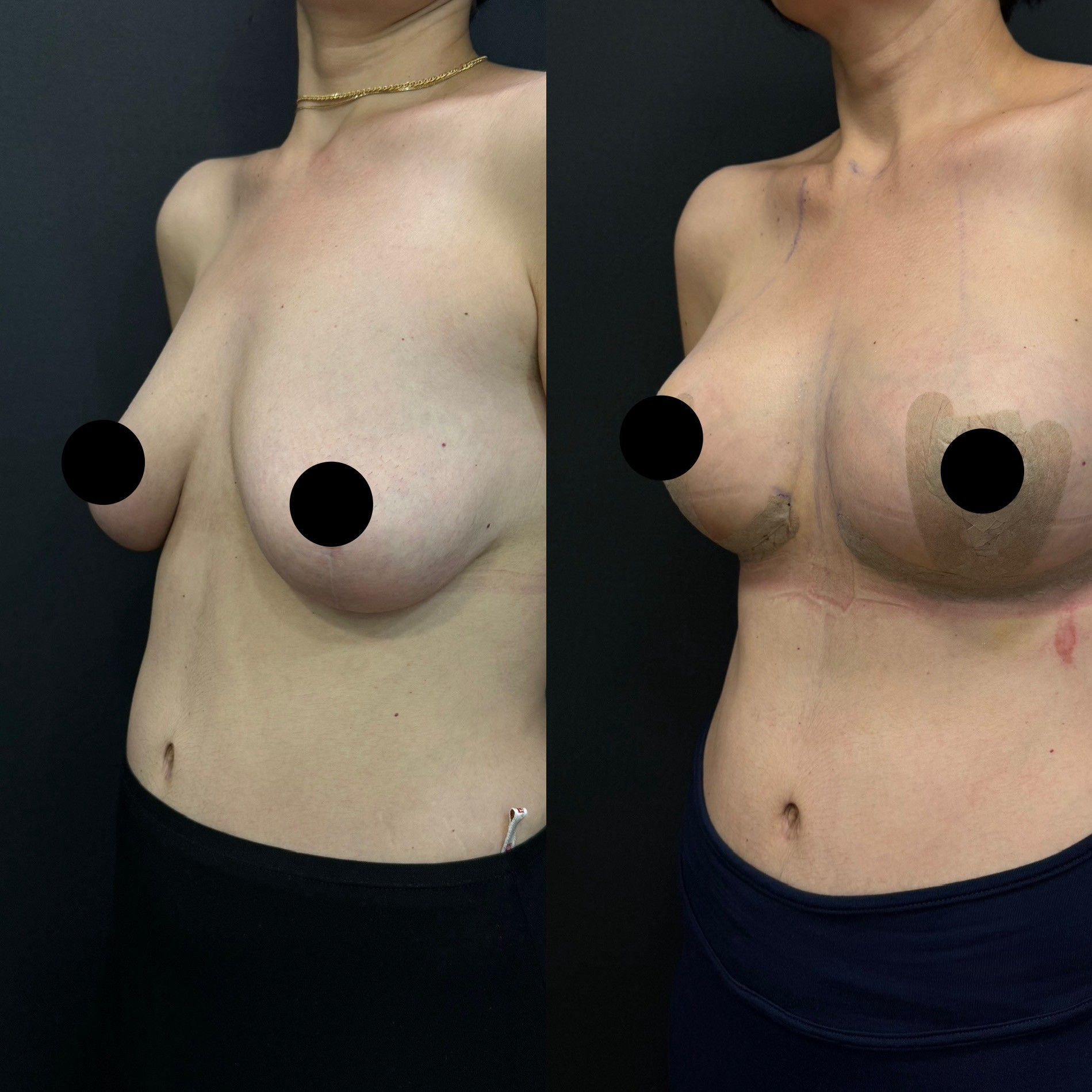 Revision breast lift with implant before after oblique view