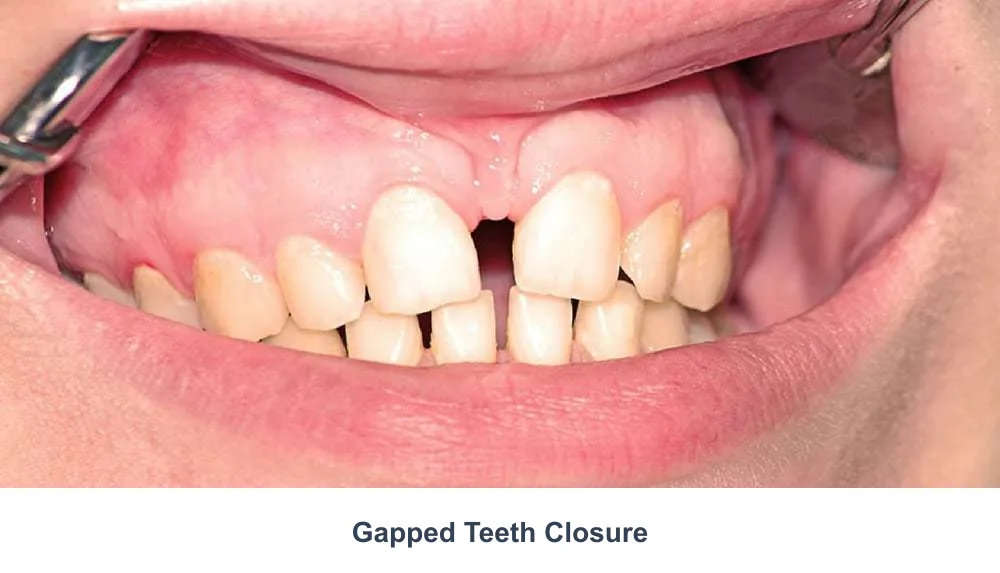 Gapped teeth spacing assessed for Invisalign clear aligner closure at COSDENT