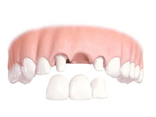 Dental Implant Supported Bridges in Toronto | Bloor Yorkville Periodontics