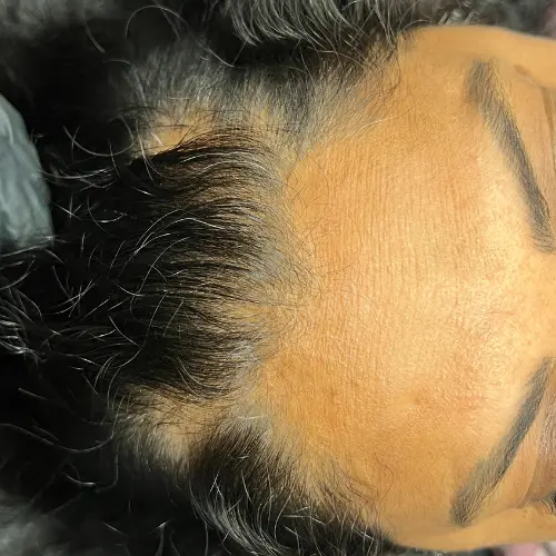 Before microneedling hair loss treatment at The Vancouver Aesthetician — visible bald patches and receding hairline