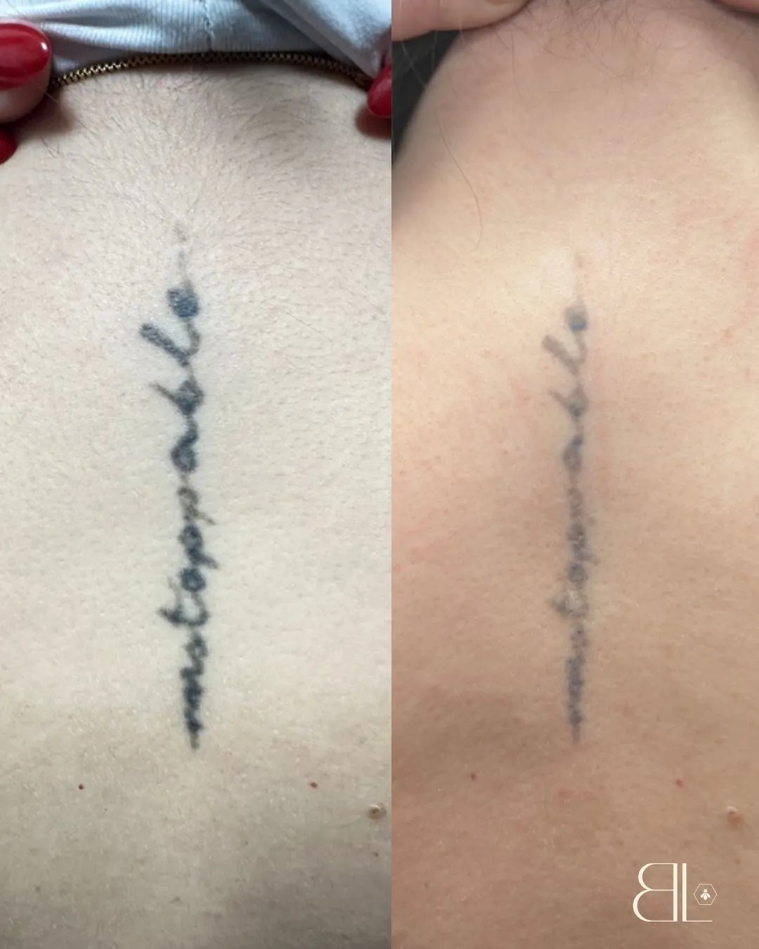 Borrar tatuaje con láser en Móstoles