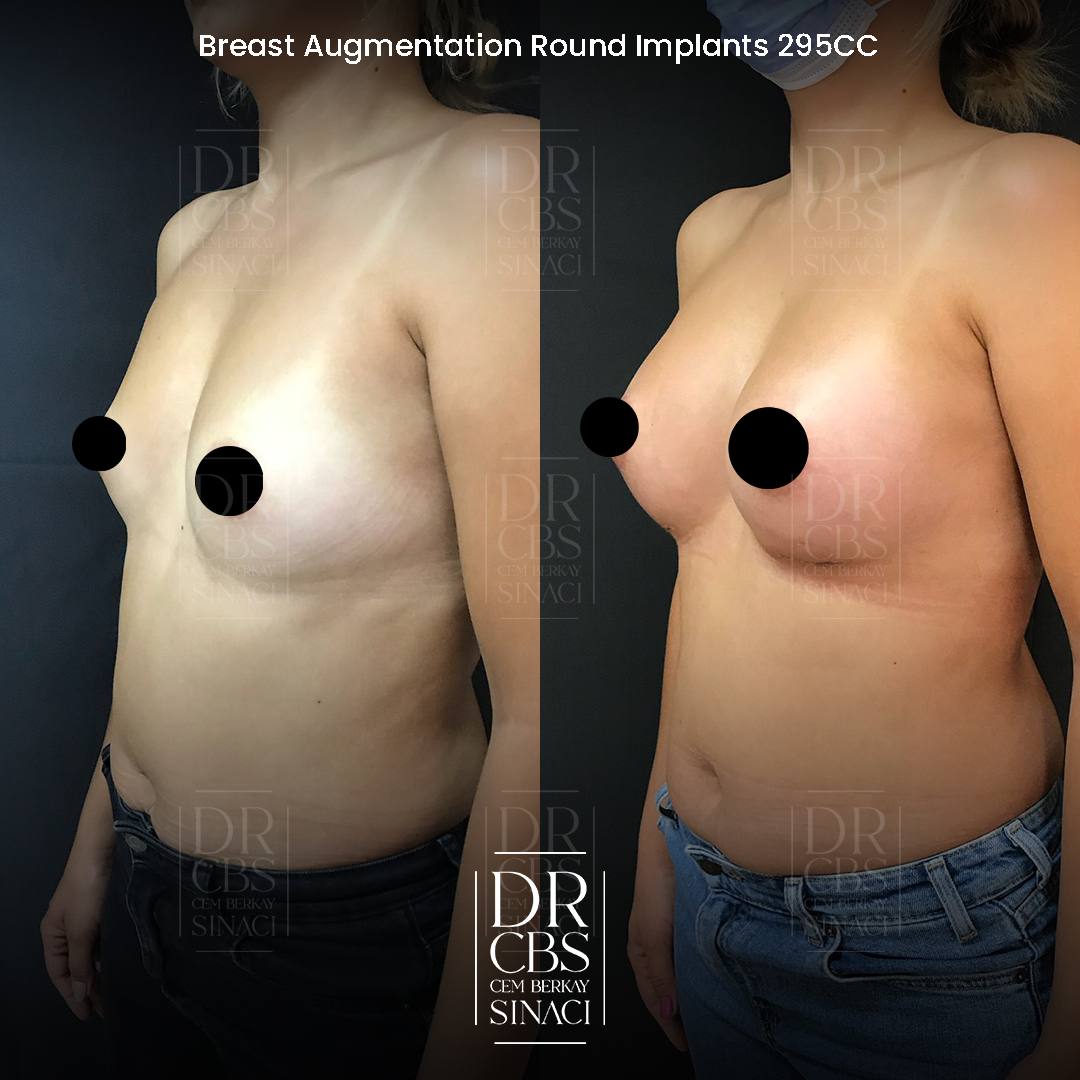 2 weeks, breast implant before after oblique view