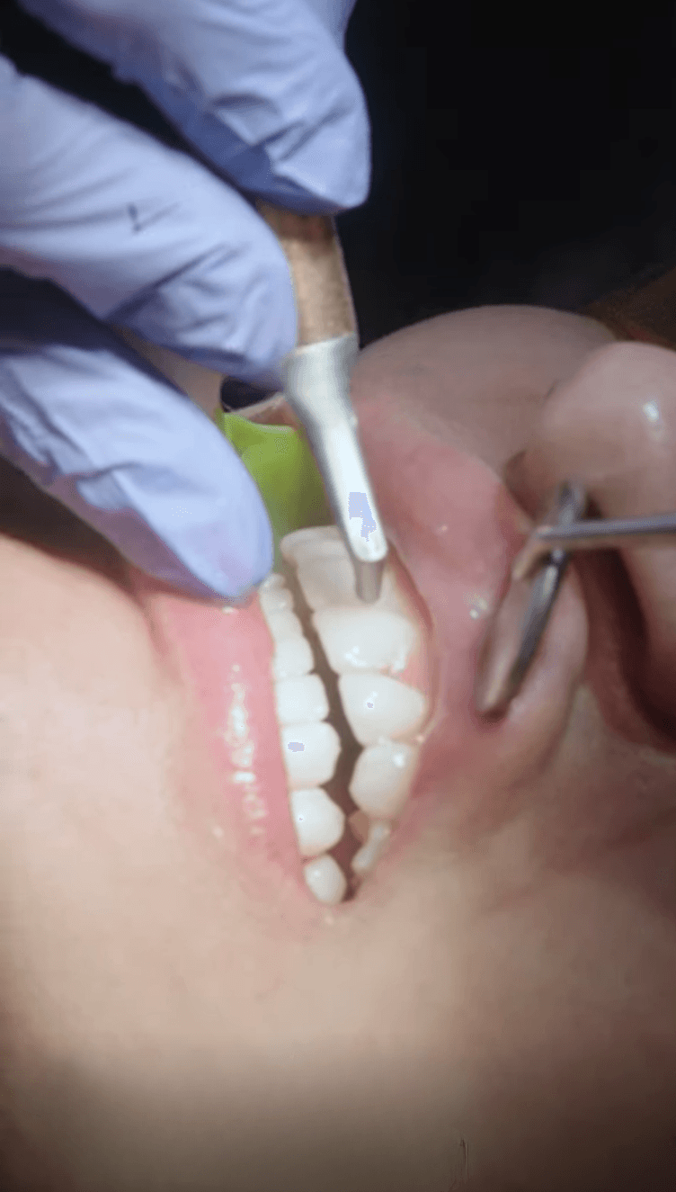 Oral Cancer Screening in North York, ON | Sovrle Dental Clinic