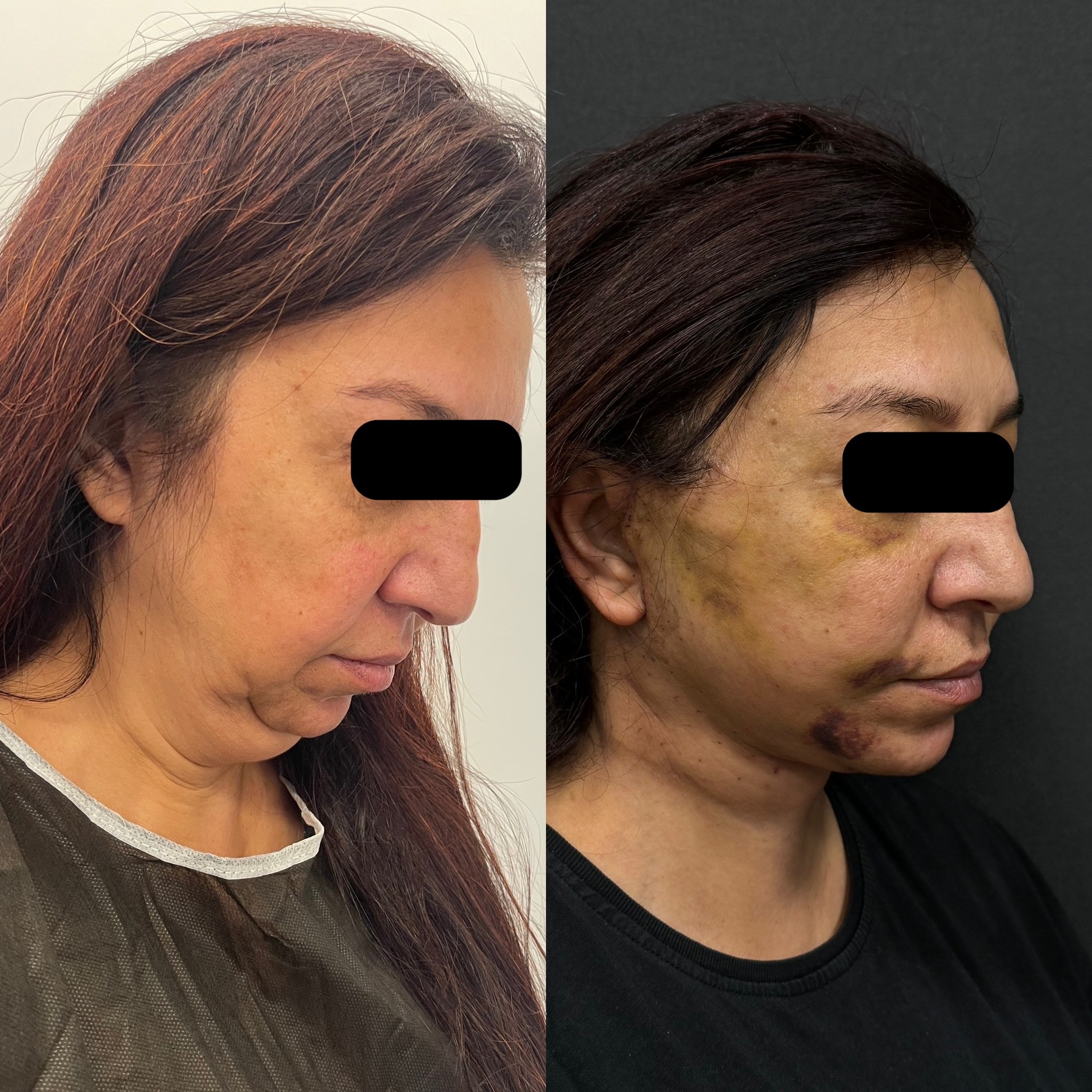 turkey neck deformity neck lift before after right oblique view