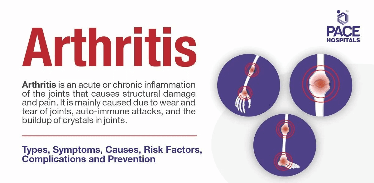 Arthritis explained graphic showing arthritis in the wrists and foot on a skeleton.