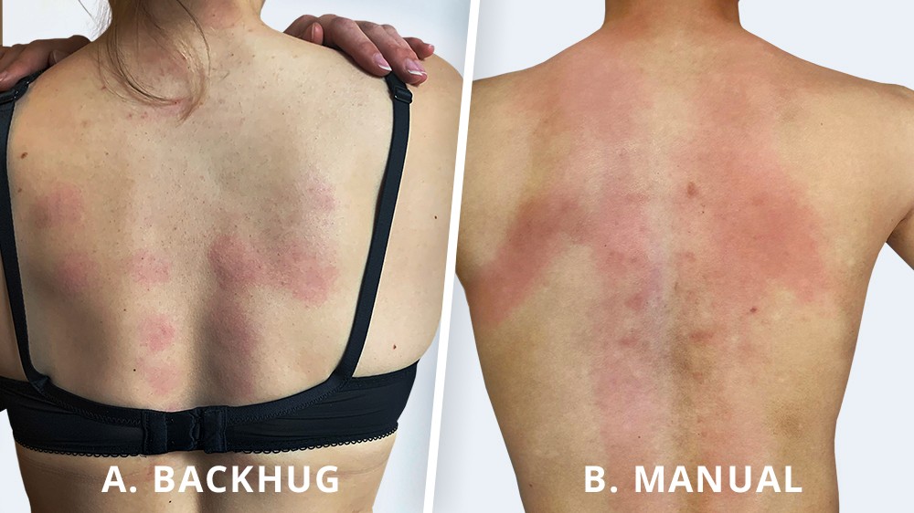 Comparison of red marks on a user's back after using BackHug (left) and manual therapy (right).