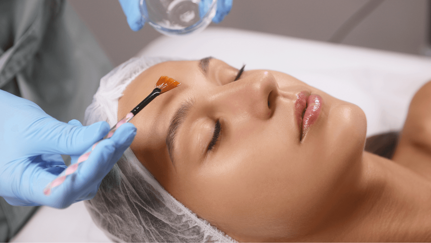 Chemical Peel vs Microneedling : Which Is Better for Your Skin?