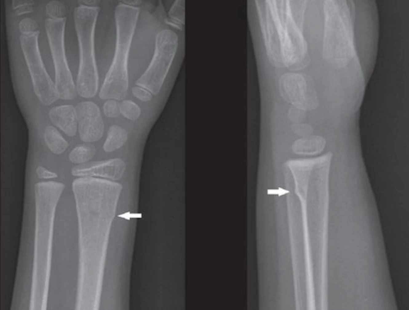 AP and lateral wrist X-rays with arrows marking an uncomplicated buckle fracture of the distal radius.
