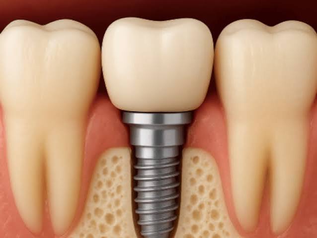 Implant treatment image