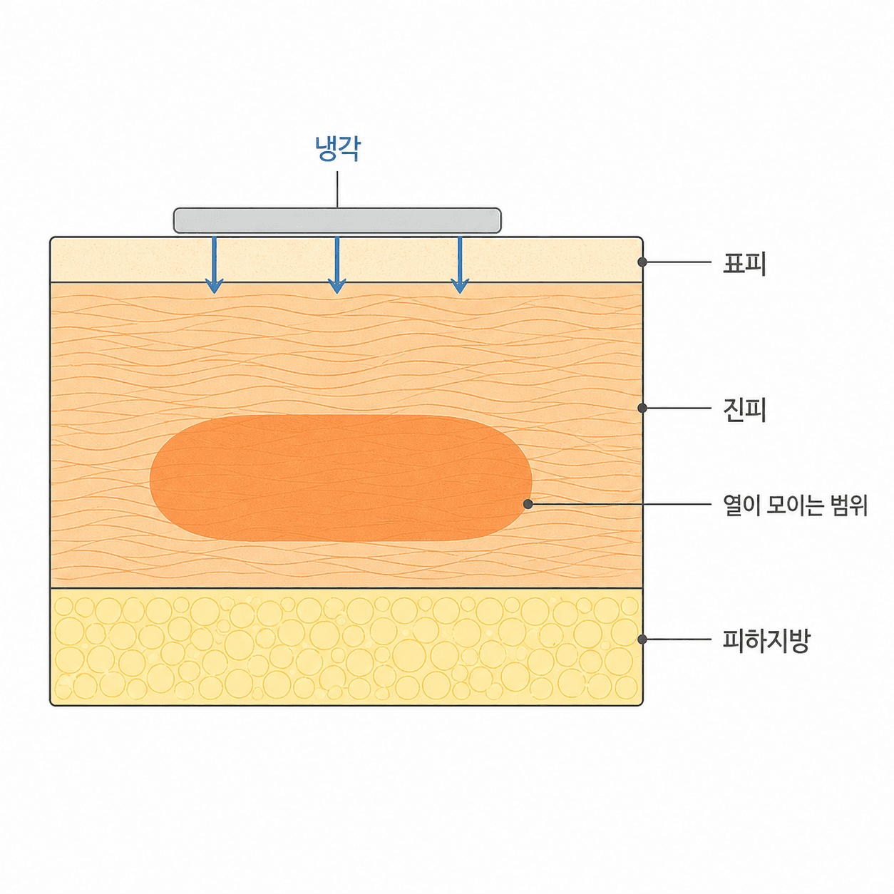 표면은 식히면서 그 아래 진피에만 열을 모으는 구조예요.