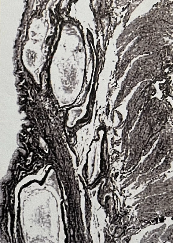 Lockerheit des submukosalen Bindegewebes bei einem 70-jährigen Mann
